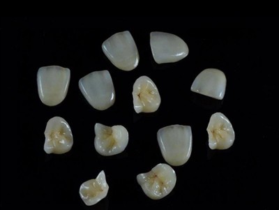 Sut i Ddewis y Glud Deintyddol Gorau ar gyfer Coronau: Canllaw Diweddaraf