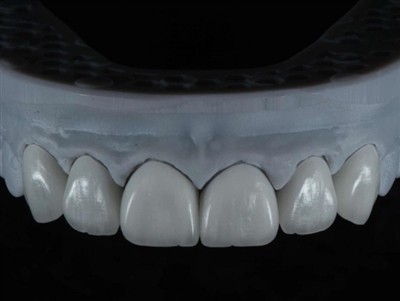 Sut i Allanoli Technegydd Lab Deintyddol i Weithio Dramor: Canllaw Cynhwysfawr