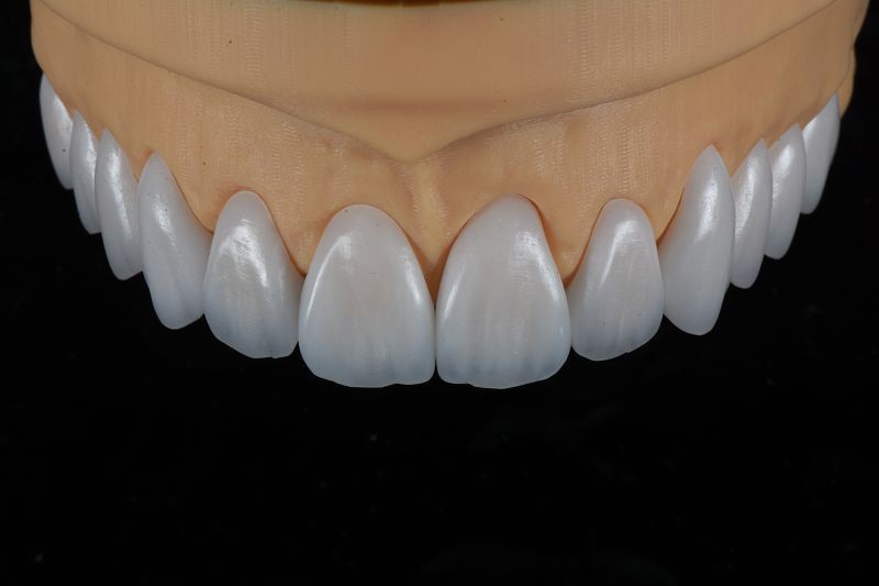 E-max veneers