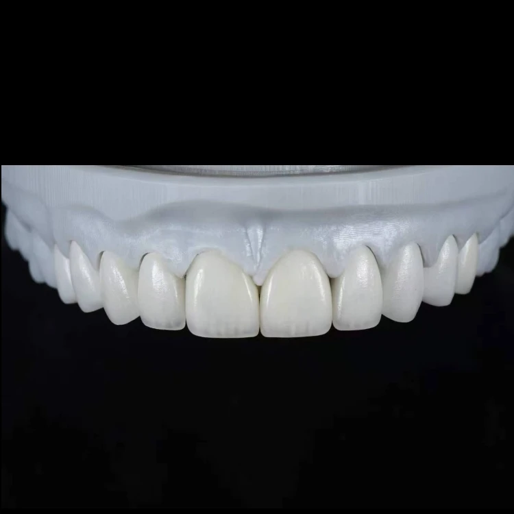 E.max Layering Veneers E.max Layering Veneers