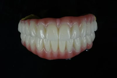Pawb-ar-X Zirconia Bridge With Pink Gingiva