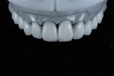 Argaenau Haenu E.max wedi'u Cynllun Digidol