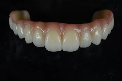 Llawn-Bwa Zirconia Bridge gyda Gingival Characterization